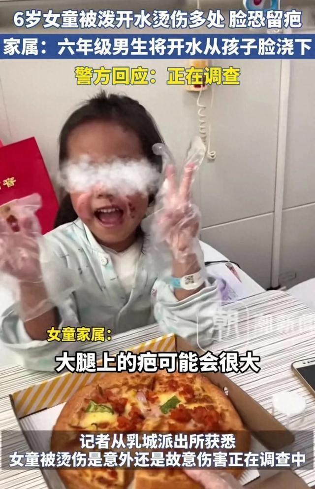女童遭开水烫伤事件