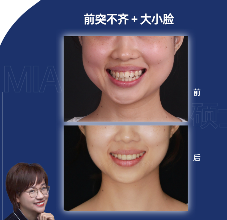 牙齿矫正谣言解析