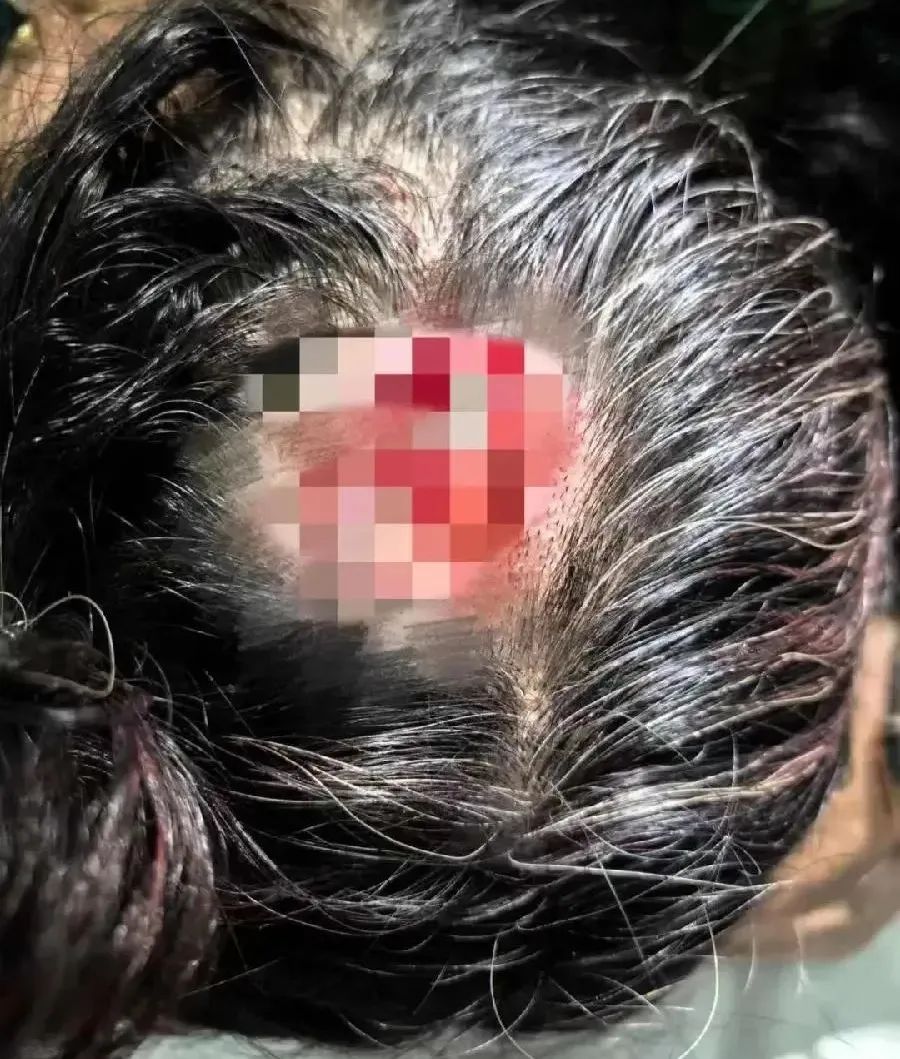 鲨鱼夹碎裂扎入头部