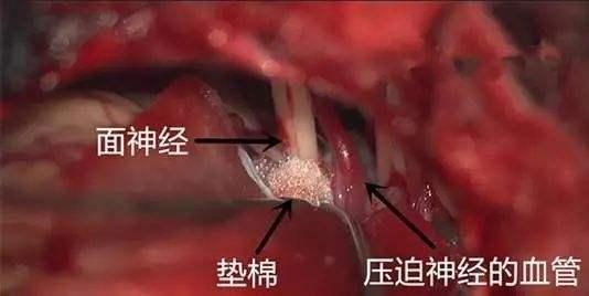 面肌痉挛最新最好治疗方法,面肌痉挛最新最好治疗方法