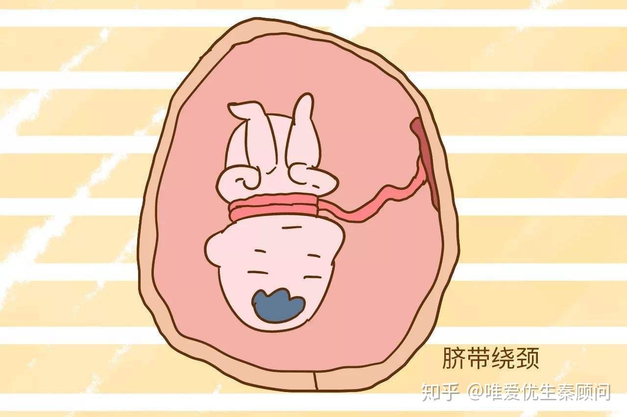 脐带绕颈的最新观察