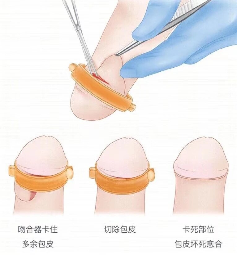最新割包皮技术详解与步骤指南