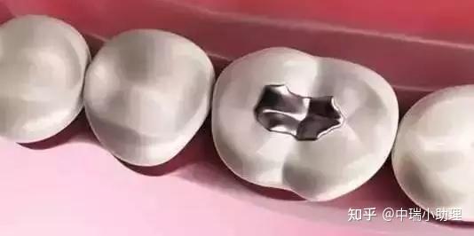 最新补牙材料